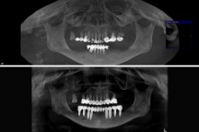 THERAPY OF THE EDENTULOUS LOWER JAW WITH 8 DENTAL IMPLANTS AND METAL-CERAMIC BRIDGE