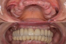 THERAPY OF BOTH EDENTULOUS  JAWS WITH DENTAL IMPLANTS AND METAL-CERAMIC BRIDGES