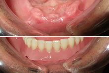 THERAPY OF EDENTULOUS LOWER JAW WITH MINI DENTAL IMPLANTS